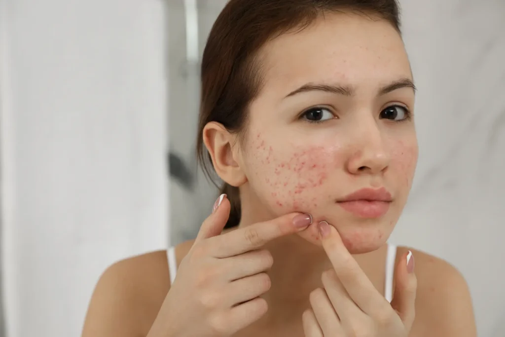 Achieve Clear, Glowing Skin Naturally with These Acne Treatments