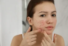 Achieve Clear, Glowing Skin Naturally with These Acne Treatments