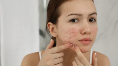 Achieve Clear, Glowing Skin Naturally with These Acne Treatments