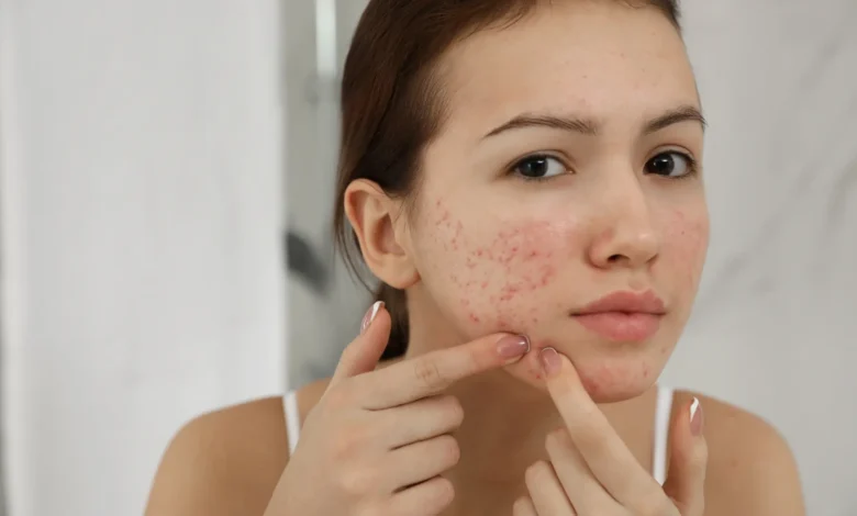 Achieve Clear, Glowing Skin Naturally with These Acne Treatments